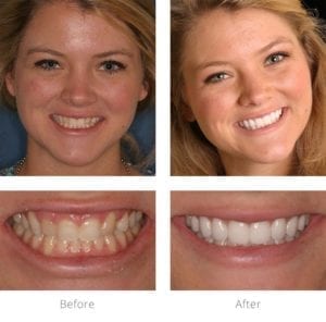 Before and after picture of a girl smiling with a before and after close-up of her teeth.