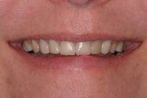 porcelain veneers from a family dentist