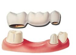 Kentucky dental bridge/alternative to dental implants