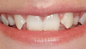 a smile with missing lateral incisors