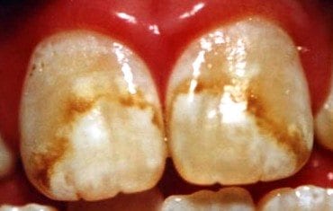 Severe fluorosis Stains