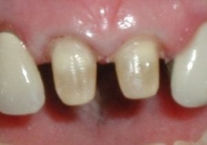 tooth preparation for porcelain crowns