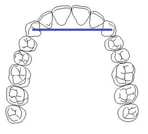 diagram of a dental bridge with a line connecting the canine teeth