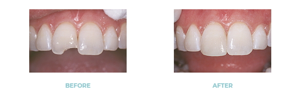 Before and after dental implants