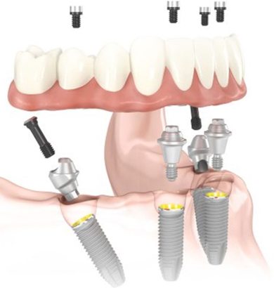 all-on-four dental implants