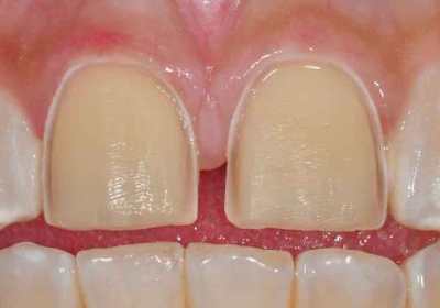 teeth prepared for porcelain veneers