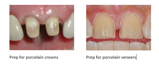 Tooth prep for both dental crowns and porcelain veneers