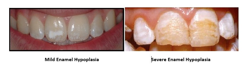 Examples of mild and severe enamel hypoplasia