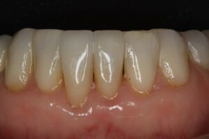 Lower incisors repaired with porcelain veneers.